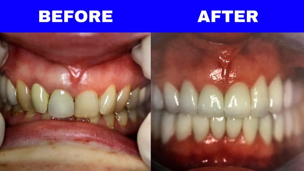 Before and After - Patient 5